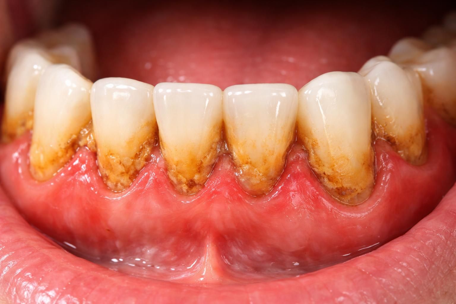 découvrez ce qu'est le tartre dentaire, comment il se forme et les risques qu'il présente pour la santé bucco-dentaire.